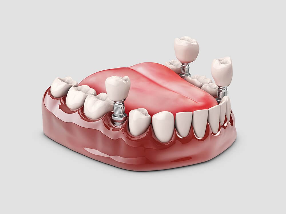 Swiper-Foto für: Zahnersatz. Ein Modell menschlicher Zähne mit Implantaten.